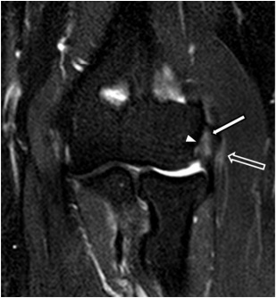 Magnetic resonance imaging of patients with lateral epicondylitis: Relationship between pain and severity of imaging features in elbow joints