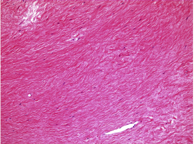 Superficial radial nerve compression due to fibroma of the brachioradialis tendon sheath: A case report