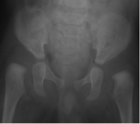Is male gender a prognostic factor for developmental dysplasia of the hip? Mid-long-term results of posteromedial limited surgery