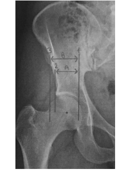 Assessing the risk of asymptomatic dysplasia in parents of children with developmental hip dysplasia