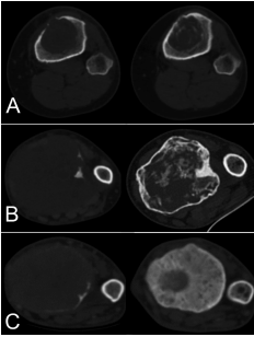A new computerized tomography classification to evaluate response to Denosumab in giant cell tumors in the extremities