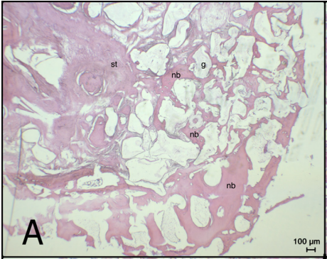 Locally administrated single-dose teriparatide affects critical-size rabbit calvarial defects: A histological, histomorphometric and micro-CT study