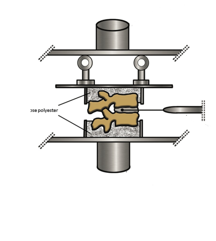 Biomechanical effects of sequential resection of the posterior ligamentous complex on intradiscal pressure and resistance to compression forces