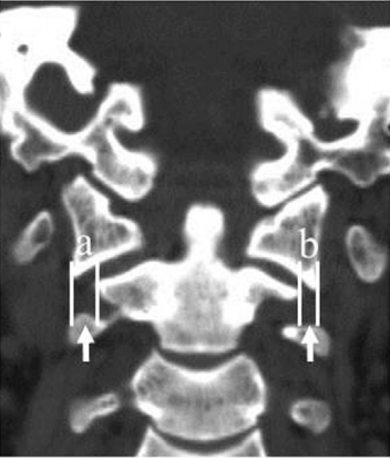 Clinical and radiological outcomes of conservative treatment for unilateral sagittal split fractures of C1 lateral mass