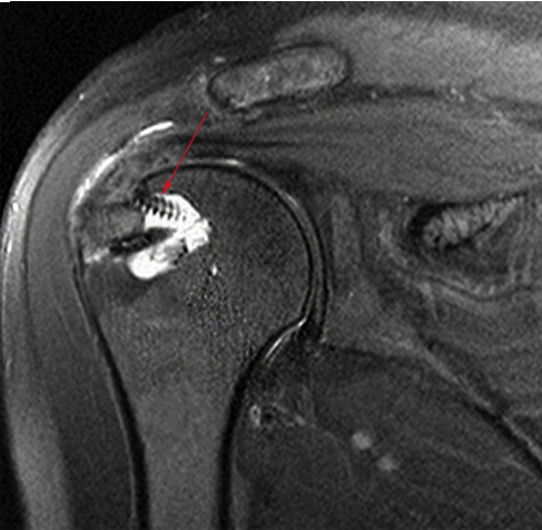 Osteolysis is observed around both bioabsorbable and nonabsorbable anchors on serial magnetic resonance images of patients undergoing arthroscopic rotator cuff repair