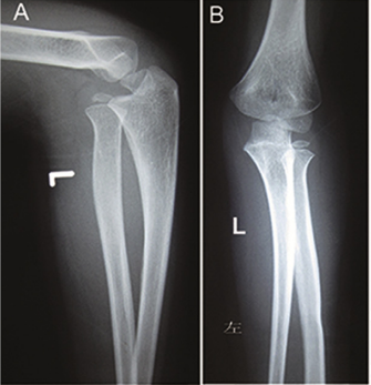 Double ulnar osteomy for the treatment of congenital radial head dislocation