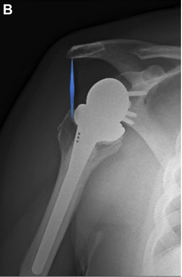 Isokinetic Evaluation of Shoulder Strength and Endurance after Reverse Shoulder Arthroplasty: A Comparative Study