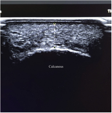 The thickness of heel fat-pad in patients with plantar fasciitis