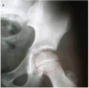 Center-edge angle values in healthy children between 5 and 14 years old in Turkey