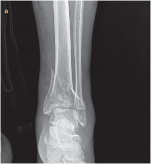 Minimally invasive medial plate osteosynthesis in tibial pilon fractures: Longterm functional and radiological outcomes