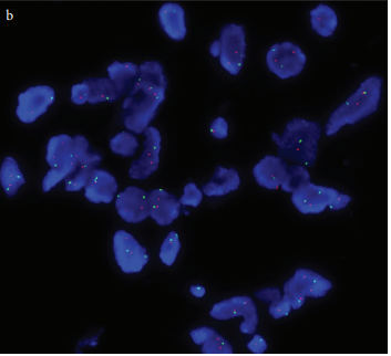 Clinicopathological value of ErbB2 gene and protein expression in osteochondroma