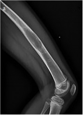 Treatment of pelvic Ewing’s sarcoma: Pros and cons of chemotherapy plus definitive radiotherapy versus surgery