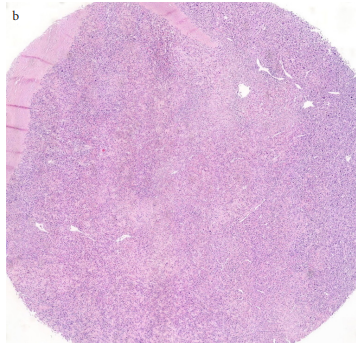 Diagnostic importance of clinicopathologic features and p16, CD34, MDM2 expression in differential diagnosis of adipocytic tumors