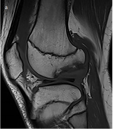 Matrix induced autologous chondrocyte implantation in the knee: Comparison between osteochondritis dissecans and osteonecrosis and effect of chondrocyte thickness on prognosis
