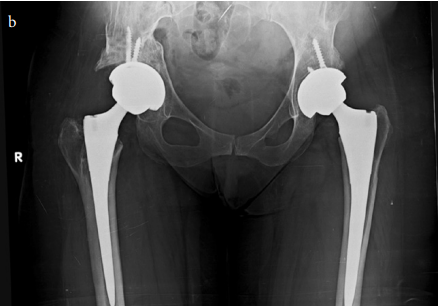 The effect of previous pelvic or proximal femoral osteotomy on the outcomes of total hip arthroplasty in patients with dysplastic coxarthrosis