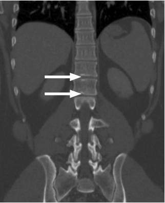 The effect of bone mineral density on development of Schmorl’s nodes in young patients