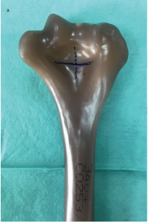 The effect of hole size on failure loads of the distal humerus fenestration in Outerbridge-Kashiwagi arthroplasty: A biomechanical study