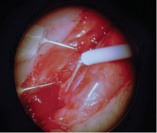 Comparison of peripheral nerve repair using ethyl-cyanoacrylate and conventional suture technique in a rat sciatic nerve injury model