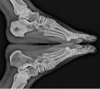 Brodie’s abscess of the calcaneus in an adult patient