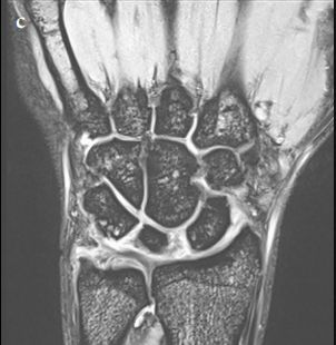 Palmar-divergent dislocation of the scaphoid and lunate treated using percutaneous pinning and pin-in-plaster: A case report